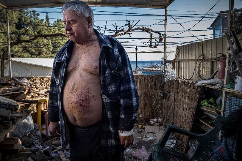 Anatoli fue uno de los heridos a causa del primer bombardeo que se produjo en Odesa, en una zona residencial al sur de la ciudad