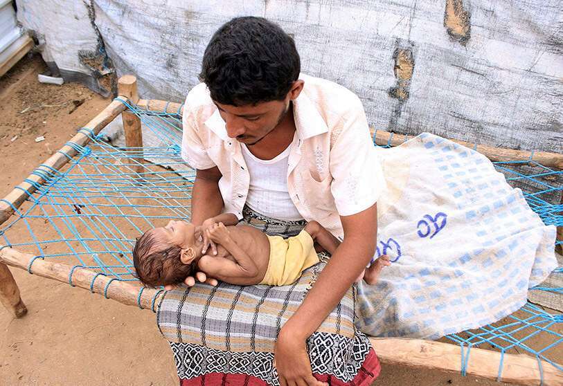 El niño yemení Meshaal Mohammad, de cuatro años de edad y que pesa nueve kilos debido a la desnutrición aguda, en el norte de Yemen, el 2 de marzo de 2021 AFP/ ESSA AHMED