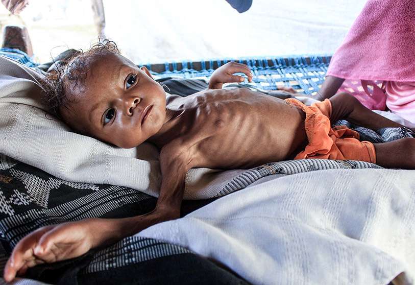 Yemen desnutrición infantil